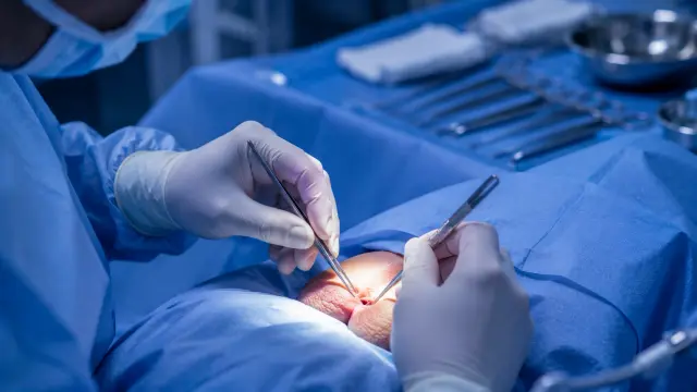 No-Scalpel Vasectomy illustration
